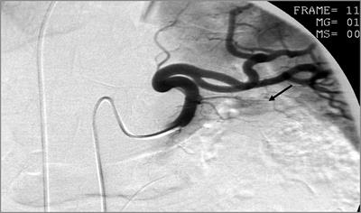 Single center experience in localization of insulinoma by selective intraarterial calcium stimulation angiography - a case series of 15 years